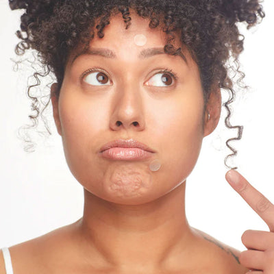 Breakout Box Acne Treatment